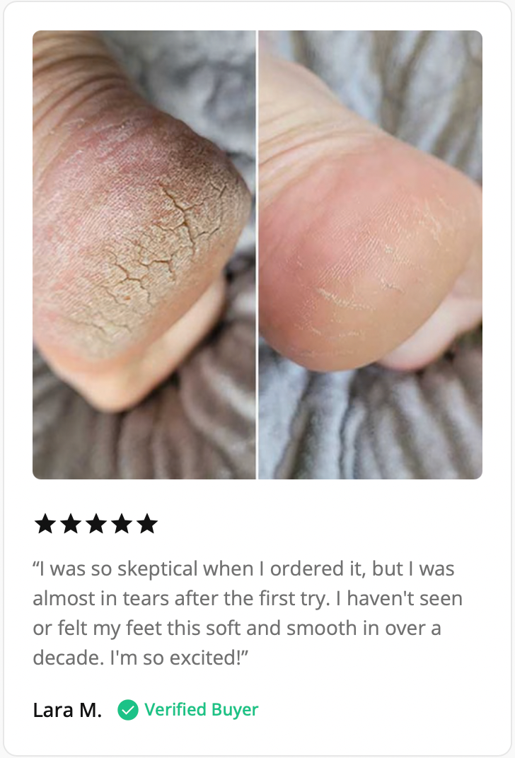 Flawless Electronic Callus Remover