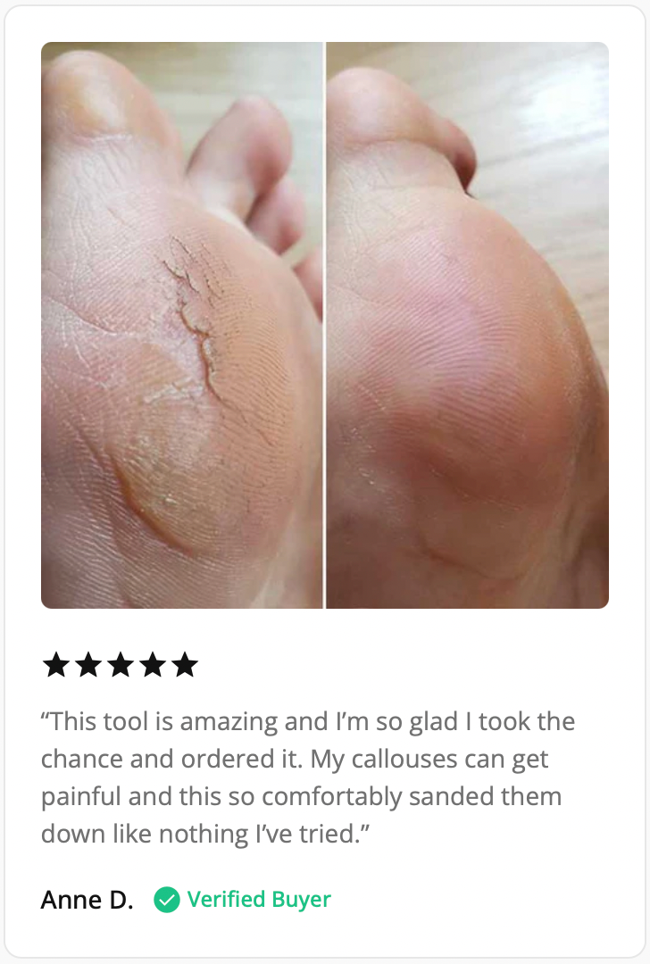 Flawless Electronic Callus Remover
