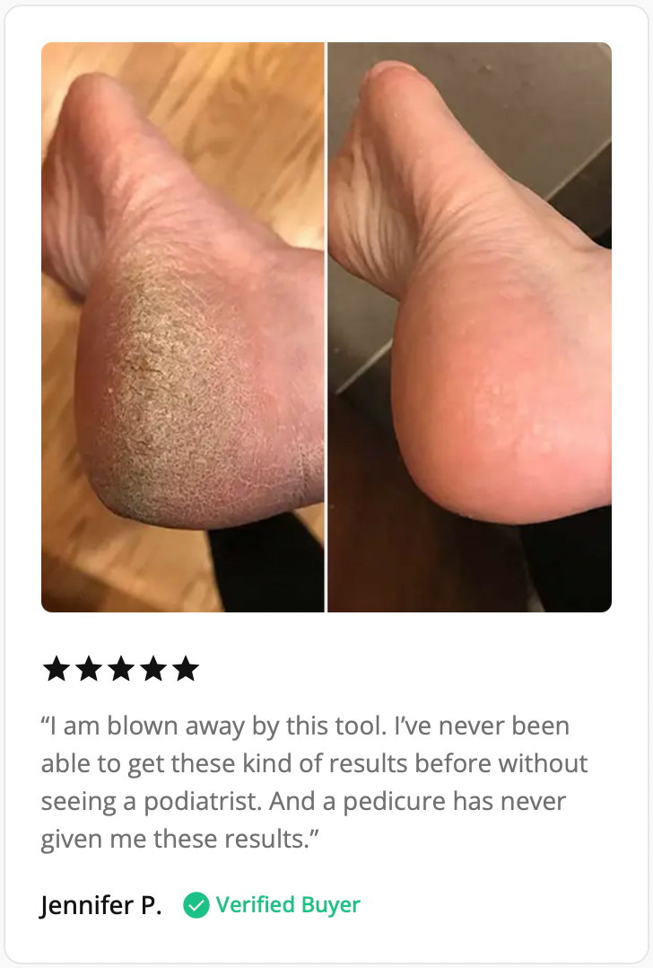 Flawless Electronic Callus Remover